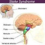 Don't Get Confused with Stroke Syndrome — VIDEO